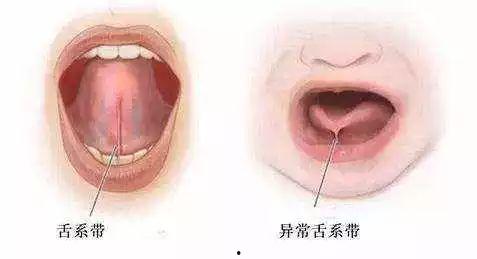 成人舌系带修剪视频播放,轻松了解手术过程及注意事项-第3张图片-日韩亚洲国产影院
